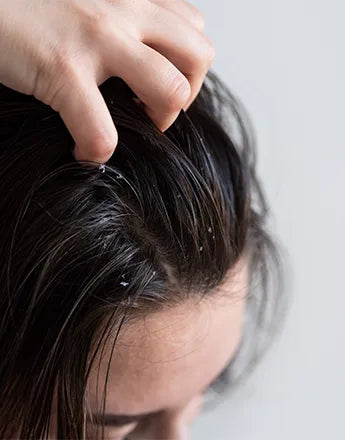 Жена нанася шампоан за себорея на скалпа си, бореща се с пърхот.